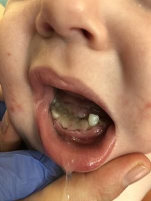 Case Report: Necrotizing Stomatitis as a Manifestation of COVID-19-Associated Vasculopathy